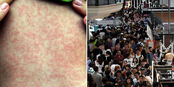 Measles scare in Sydney