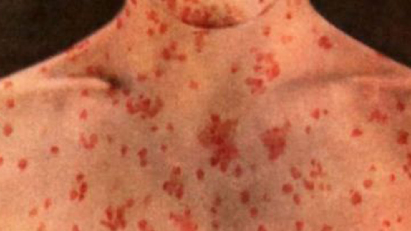 Measles alert renewed for NSW
