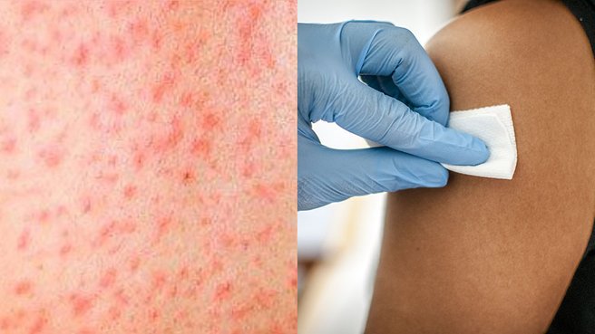 Measles alert renewed for NSW