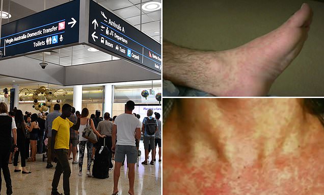 Measles warning at Sydney and Canberra airports