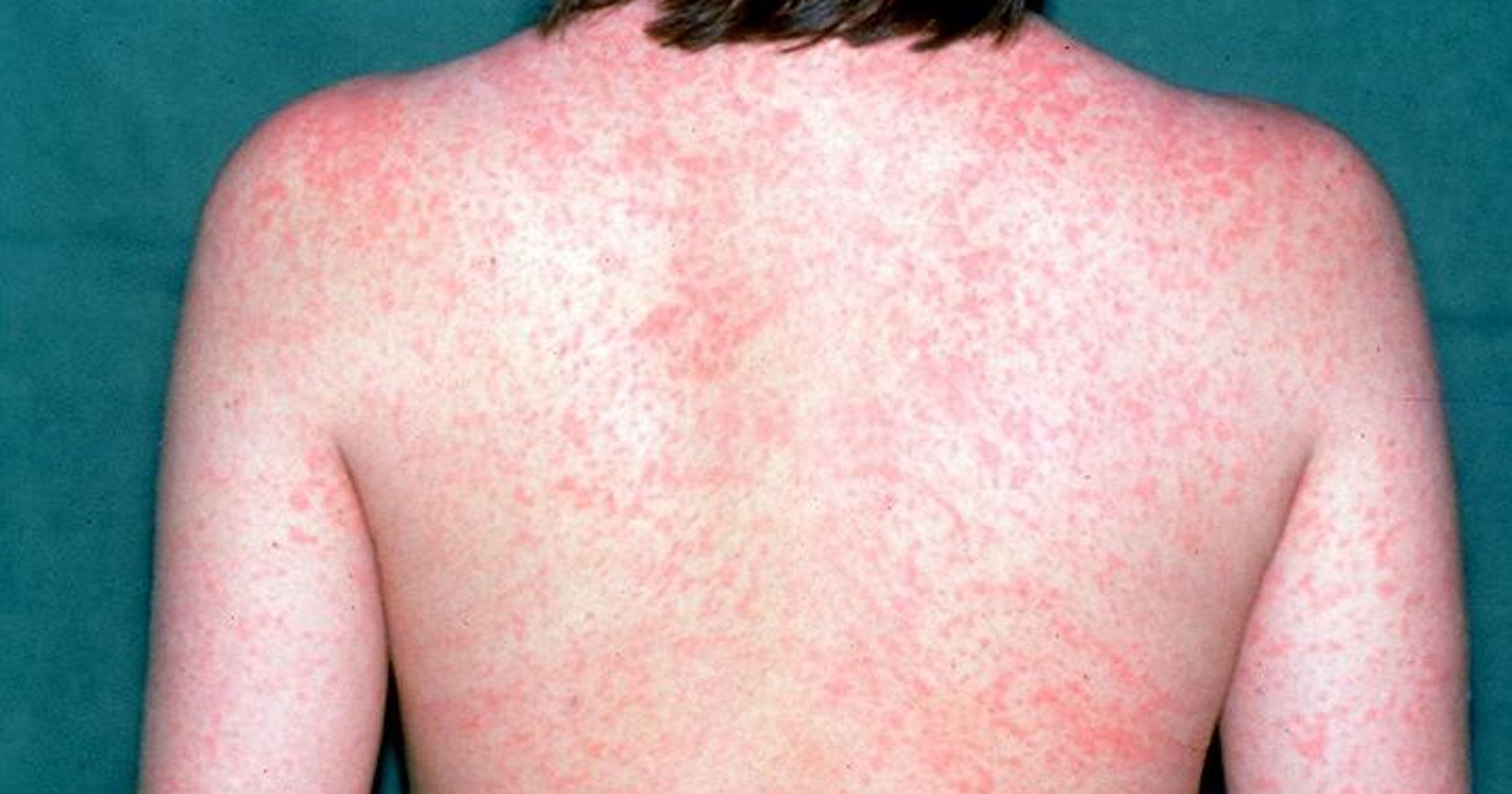 Measles health alert issued in two states