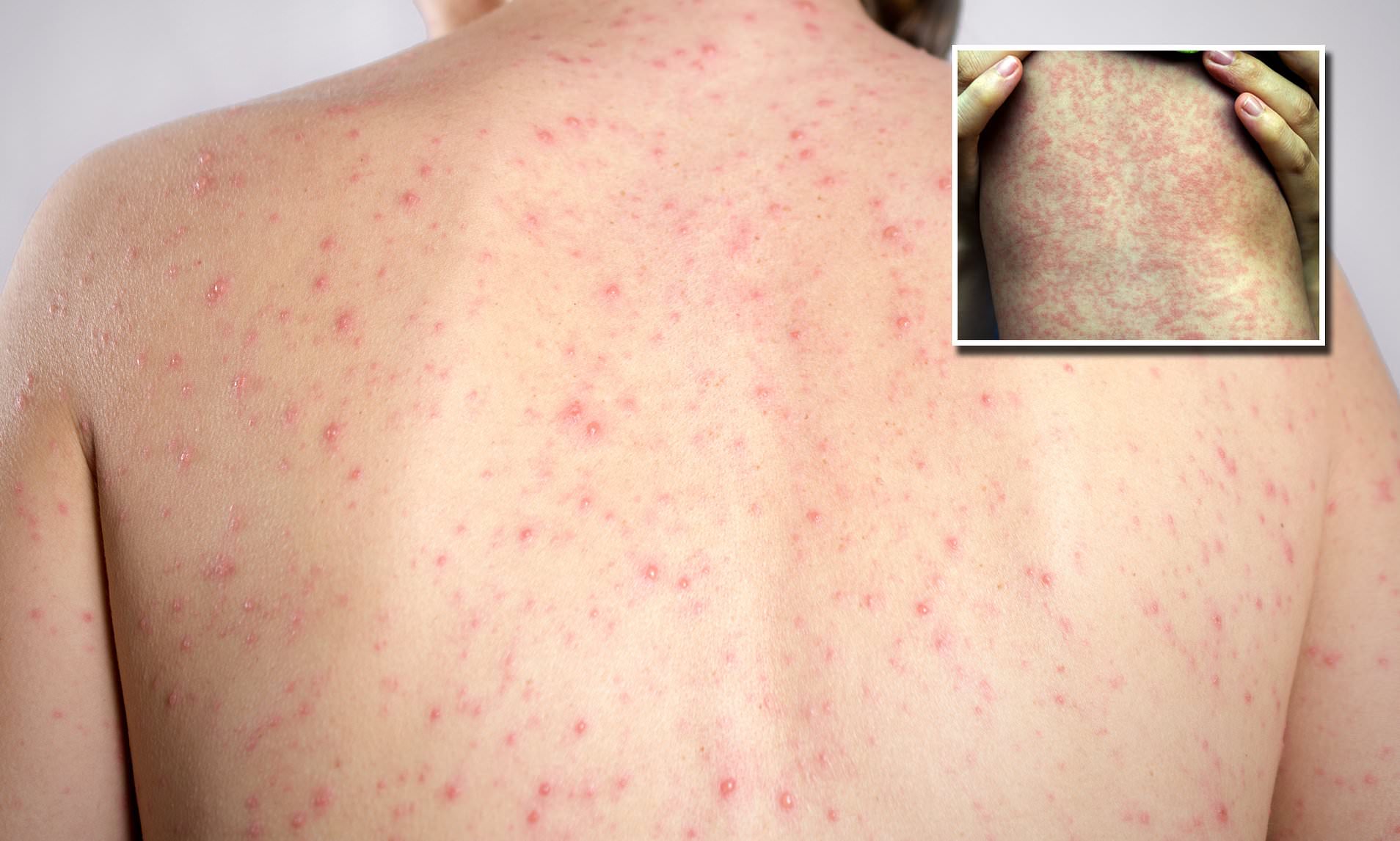 Measles warning issued for NSW north coast 